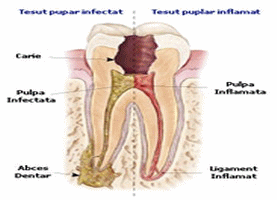 Endodontia dentara - cabinetul stomatologic DCC STOMADENT - stomatologie